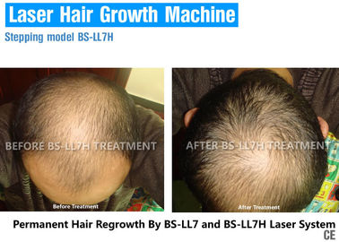 Dioden-Laser-Behandlungs-Haar-Wachstums-Laserlicht-Gerät