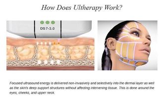 Mehrfacher Patronen-Ultraschall HIFU, der Maschinen-schmerzlose Behandlung abnimmt