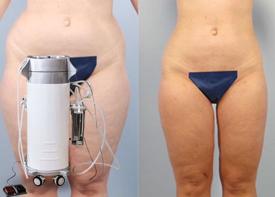 Fett-/Cellulite-Reduzierungs-Energie unterstützte das Abnehmen der Schönheits-Ausrüstung mit ölfreier Vakuumpumpe