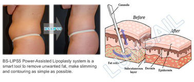 Körper-umreißende Energie unterstützte Fettabsaugungs-Ausrüstung für Körper-Sculpting Behandlungen