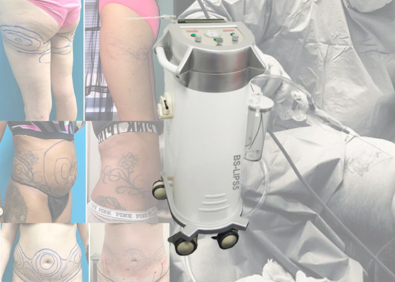 Fettabsaugungs-Maschine Abdominoplasty der plastischen Chirurgie chirurgische für Bauch-Biesen-/Magen-Fettabsaugungs-Chirurgie