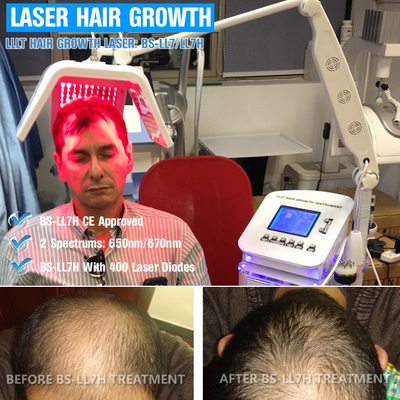 vertikale Laser-Ausrüstung der Dioden-650nm für Haar Regrowth